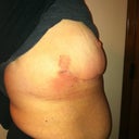 Side view with the itchy rash