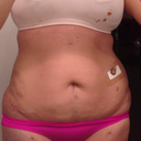 About 4 days post-op.