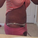 Post Operation Side View1