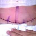Day after my Surgery