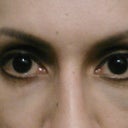 3 months + 1 week. I still have a little bit of bruising but my eye shape is restored and my peripheral vision problem is almost completely resolved :-)