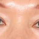 Asian Double Eyelid Surgery Before And After