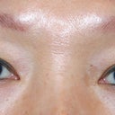Asian Double Eyelid Surgery Before And After