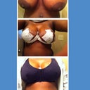 Before and after(5 days post op)