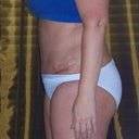 19 days post op