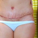 19 days post op--Appy and hyst.  scars gone.  Belly button sutures removed on yesterday.