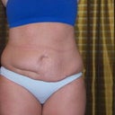 Pre op  --Notice the appendectomy scar