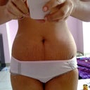 10 day after surgery