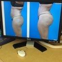 Pre op surgery 1/ Post op surgery 2