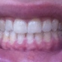 Without Trays #14 in:
I don't know why the lighting made some of my teeth look yellow in these photos, ugh.. they're not yellow in real life LOL