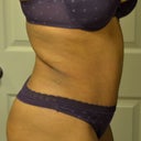 6 weeks post opt! Representing "Prince" in my purple with the booty out!