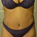 6 weeks post opt! Purple rain! Purple rain!