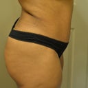 6 weeks post opt! I still have stretch marks but it's all good! They are like braille when the lights go out! Feel them and read along for one hell of a adventure!