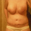 day 23 post op