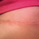 4 weeks po, scar