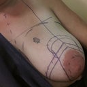 Day of surgery - All drawn on