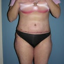 1 week post-op