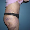 1 week post-op..you can still see the markings the doc made and some ugly bruising from the lipo on lateral thighs.