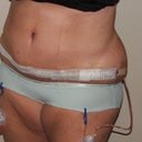 7 Days Post Op