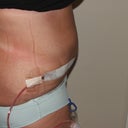 7 Days Post Op