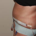 7 Days Post Op