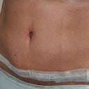 7 Days Post Op