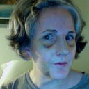 Day after cast removal