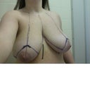 Before with surgeons drawings!!