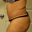 19 days post opt! You can really see the swelling in this pic but it is 100 times better than it was last week!