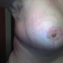 Right breast