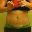 one week post op