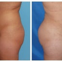 Before on the right- After on the left... Pictures taken at Dr.Ghavami's office. And he wants me to be thankful for this??? Pffft!! He is a joke!