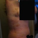 Right side - 3 days after.  Its hard to take post op pictures of yourself in a mirror when you can barely move. LOL