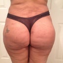 21 days post op