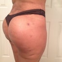 21 days post op