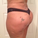 21 days post op