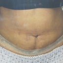 5 weeks post tt