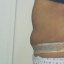 5 weeks post tt