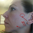 Disappointed, as I was initially pleased with the results of the fraxel treatments. My skin looked better a month ago than it does now :(.  This photo shows the pigmentation differences that have begun to appear in my skin.