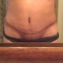 4 Weeks Post Op.  Do not like how dark my incision looks, but still no regrets as it is much better than before.  Hoping it will still lighten some more.