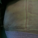 19 days PO of side... line on side from garment still swollen