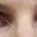 1 week after Botox.  I am smiling in both pictures. Both pictures are unretouched.  Both pictures were taken with the same camera in the same lighting.  I am wearing the same make-up in both pictures. The only difference is the Botox 1 week later.