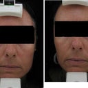 This was before and six weeks after.  See why I was disappointed.  Led to believe more fullness than this.