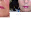 The picture is backwards but the right in before in 2008 and left is one month after the silicon 1000 done 12-09.  Seems to have gotten a bit fuller over time but I am still in distress about downturn corners when I don't smile and uneven lips.