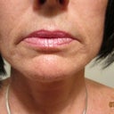 The last two pictures are from July 2012 and no other injections since 12-09;  however, seems that 10 microcurrent tx may have caused the collegen to fill out so if I could just find a reason to smile more often.....but now all of a sudden, I can't believe the bags and folds under my eyes when i smile.  Is there any end to this?  I went for consult but the doctor only said that it takes a lot more injections with silikon to achieve results and then AFTERWARDS, the receptionist told us that she had it in the corners of her mouth to end the sad look but I had to cancel and I wish the doctor had discussed this with me as I didn't have enough information as there is also a surgery that addresses this but one other doc said it will leave a scar but the pictures looked good and it starts with "A" but i can't remember the name.