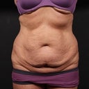 Before surgery February 2012