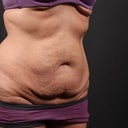 Before surgery