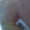 Very bruised on the left
