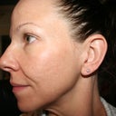 One month post-fraxel #3 (and final) with no makeup. You can see that the sunspots are gone, but the acne scarring is not significantly improved from the before pictures.