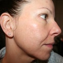 One month post-fraxel #3 (and final) with no makeup. You can see that the sunspots are gone, but the acne scarring is not significantly improved from the before pictures.